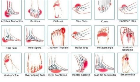 Plantar Fasciitis Boot Relive Your Severe And Chronic Pain Quickly