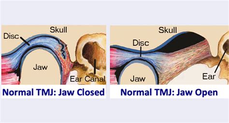 Temporo Mandibular Joint Disorders — The Jaw Physio