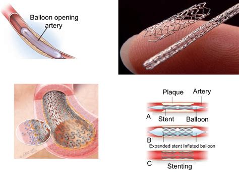Drug Eluting Stent And Placement Of Stent In The Coronary Arteries