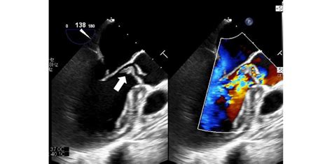 Transesophageal Echocardiogram Findings Of The Aortic Valve A Large