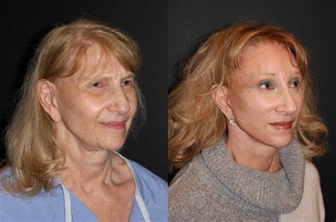Deep Plane Facelift Before And After Dr Andrew Jacono Body Surgery