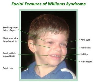 Characteristics An Educator S Approach To Williams Syndrome