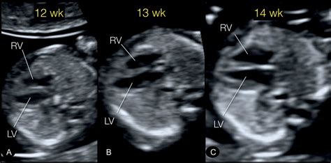 Fetal Cardiac Examination In Early Gestation Obgyn Key