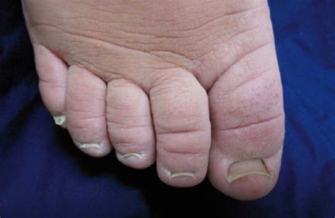 Ski Jump Toenails A Phenotypic Manifestation Of Primary Lymphedema Steven M Dean