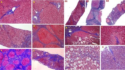 Histology Of Fibrosis And Cirrhosis A Masson Trichrome Staining