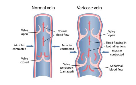 Chronic Venous Insufficiency El Paso Tx Imaging And Interventional