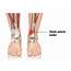 Anterior Tibial Tendonitis  Foot And Ankle Specialists Of The Mid Atlantic