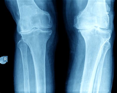 X Rays And Mri For Knee Arthritis Dr David Geier Sports Medicine