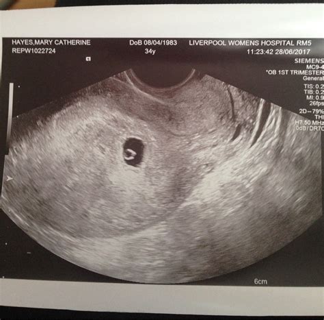 Can I See You 5w 6d Scan Pictures Please Netmums Chat
