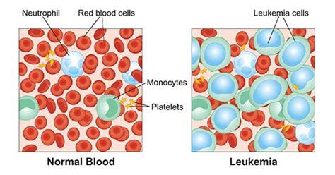 Leukemia Cells Vs Normal Cells