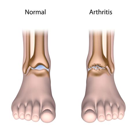 Ankle Osteoarthritis Colorado Pain Care