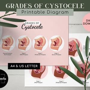 Printable Diagram Of Cystocele Grading Stages Of Cystocele Etsy UK