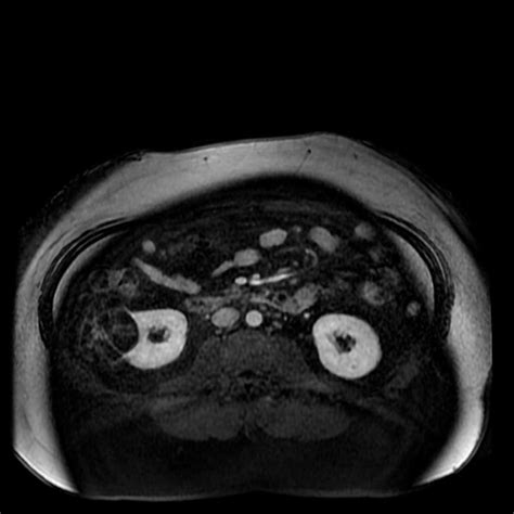 Multilocular Cystic Nephroma Of The Kidney Body Mr Case Studies