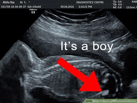 How To Read An Ultrasound Picture Wiki Pregnancy English