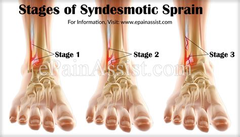 Syndesmotic Sprain Or Syndesmotic Ankle Spraincausessymptoms