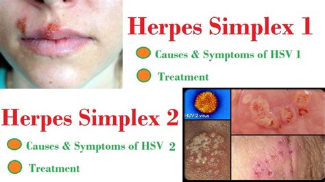 Herpes 1 Vs 2 Arthritis Kesehatan