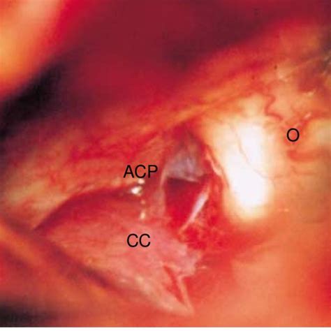 The Picture Showing Opened Carotid Cistern Optic Nerve And Anterior