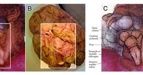 Michelangelo hid brain stem in God's throat