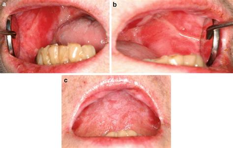 White And Red Lesions Of The Oral Mucosa Springerlink