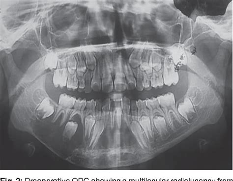 Figure 1 From Giant Aneurysmal Bone Cyst Of The Mandible Semantic Scholar