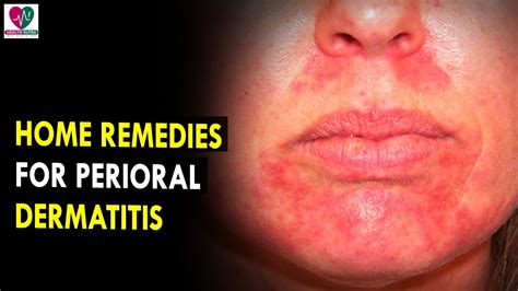 Home Remedies For Perioral Dermatitis Health Sutra Best Health