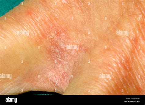 Scabies Lesions Between Fingers Stock Photo Alamy