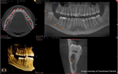 3d X Rayct Scan Vancouver Bc Vancouver Dental Specialty Clinic