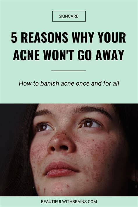 Your Acne Wont Go Away This Is Why Beautiful With Brains