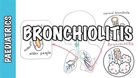 Bronchiolitis Causes Pathophysiology Signs And Symptoms Treatment