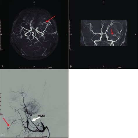 Brain Magnetic Resonance Angiography A B And External Carotid