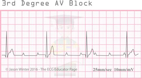 Before we return to the case study finally, a 3° atrioventricular block is a complete heart block. 3rd Degree AV Block (Complete Heart Block) #Clinical ...