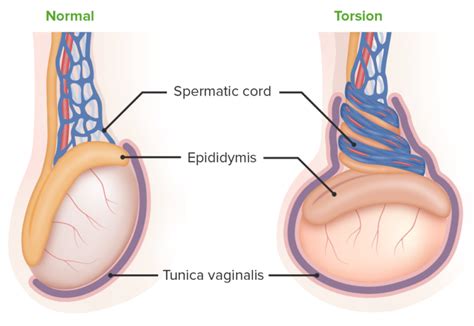 Testicular Torsion Concise Medical Knowledge