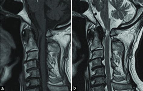 Preoperative Magnetic Resonance Imaging Mri T1wi And T2wi Sagittal