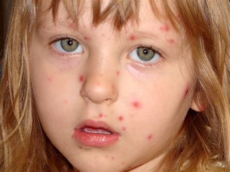 Chickenpox Symptoms