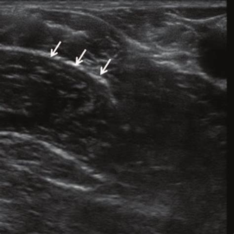 Ultrasound Image Of The Lateral Femoral Cutaneous Nerve Arrow Figure