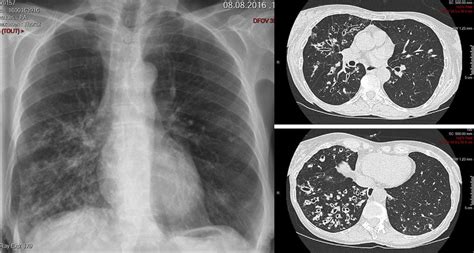 Chest X Ray And Ct Scan Showing Bronchiectasis With Air Fluid Levels