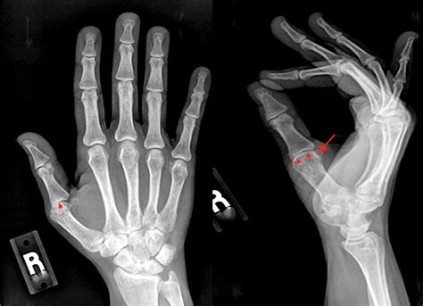 Mr Imaging Of Rheumatoid Arthritis Radsource