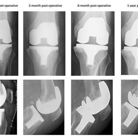 Kellgren And Lawrence Classication System Of Osteoarthritis Severity