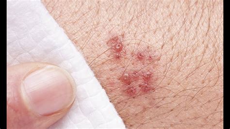 The Basics What You Should Know About Shingles Youtube