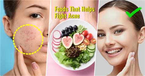 10 Food Types That Help Fight Acne
