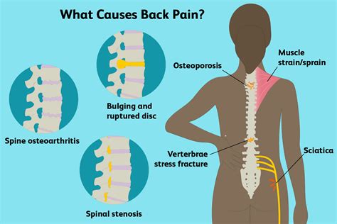 Lower back pain can be caused by problems with the spinal muscles, nerves, bones, discs or tendons. Upper & Lower Back Pain Causes - Montreal Clinic - Medium