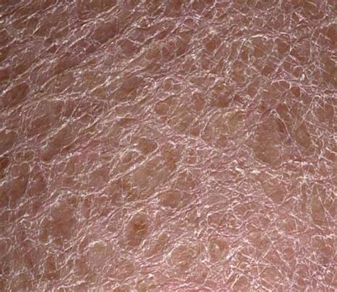 Scaly Skin Patches On Legs Dorothee Padraig South West Skin Health Care