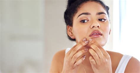 The Best Way To Treat Hormonal Acne According To Dermatologists