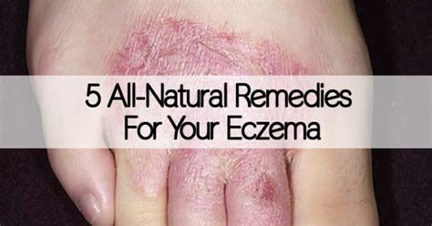 5 Natural Remedies For Eczema Healthy Holistic Living