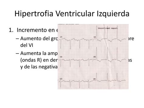 Ppt Hipertrofias Ventriculares Powerpoint Presentation Free Download