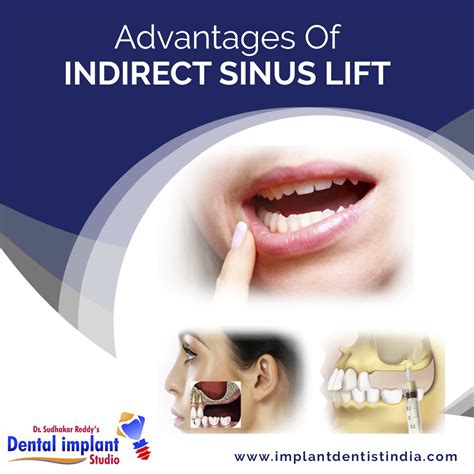 A Sinus Lift Procedure Is Essentially Done To Increase Bone Height And
