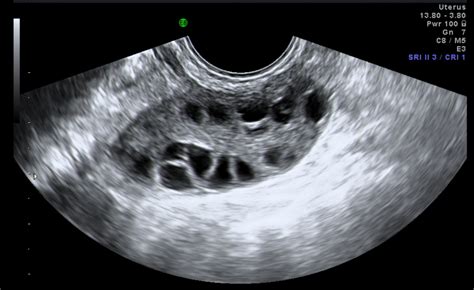 Chapter 5 Benign Ovarian Cysts Melaka Fertility