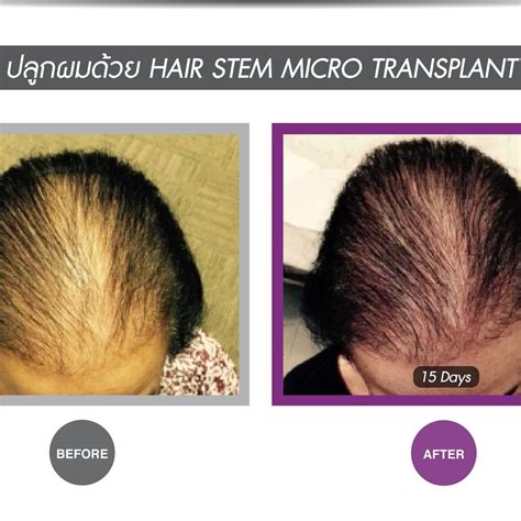 Hair Stem Cell Treatment For Hair Loss Apex Medical Center