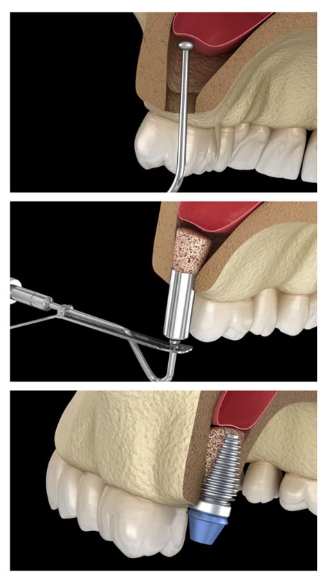 Sinus Lift Surgery Sinus Augmentation Procedure Ottawa