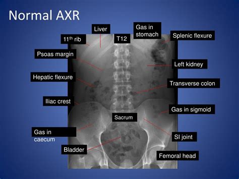 Ppt Abdominal X Ray Radiological Signs Powerpoint Presentation Free Download Id